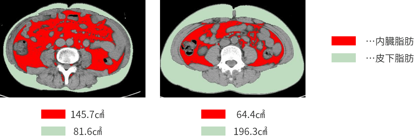 内臓脂肪CT画像